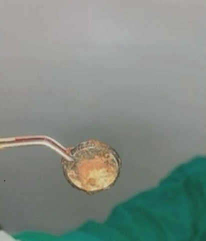 Niño que tragó una pila, se encuentra internado en grave estado
