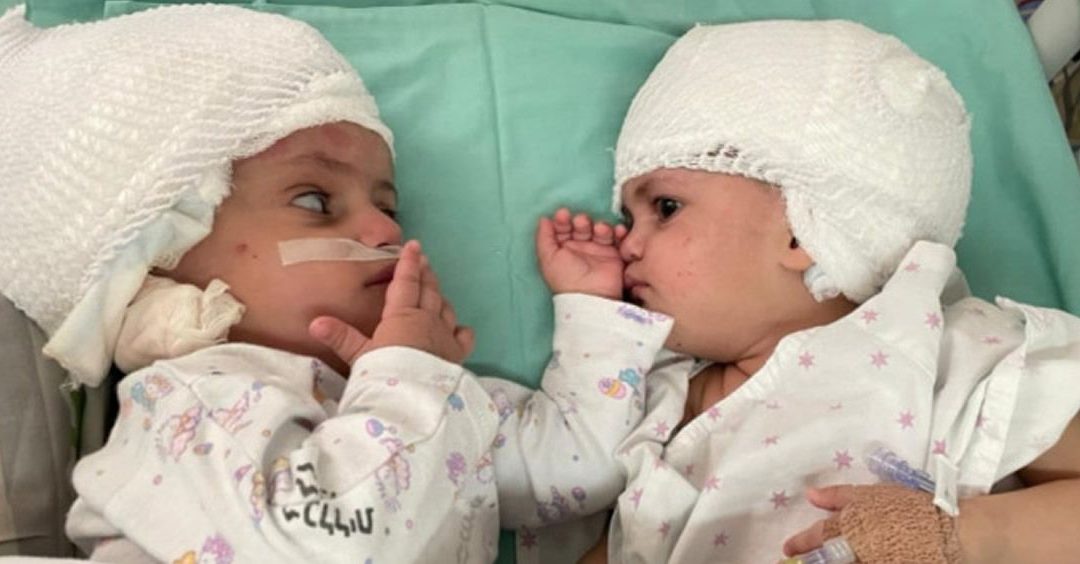 En Israel, lograron separar a siamesas unidas por la cabeza