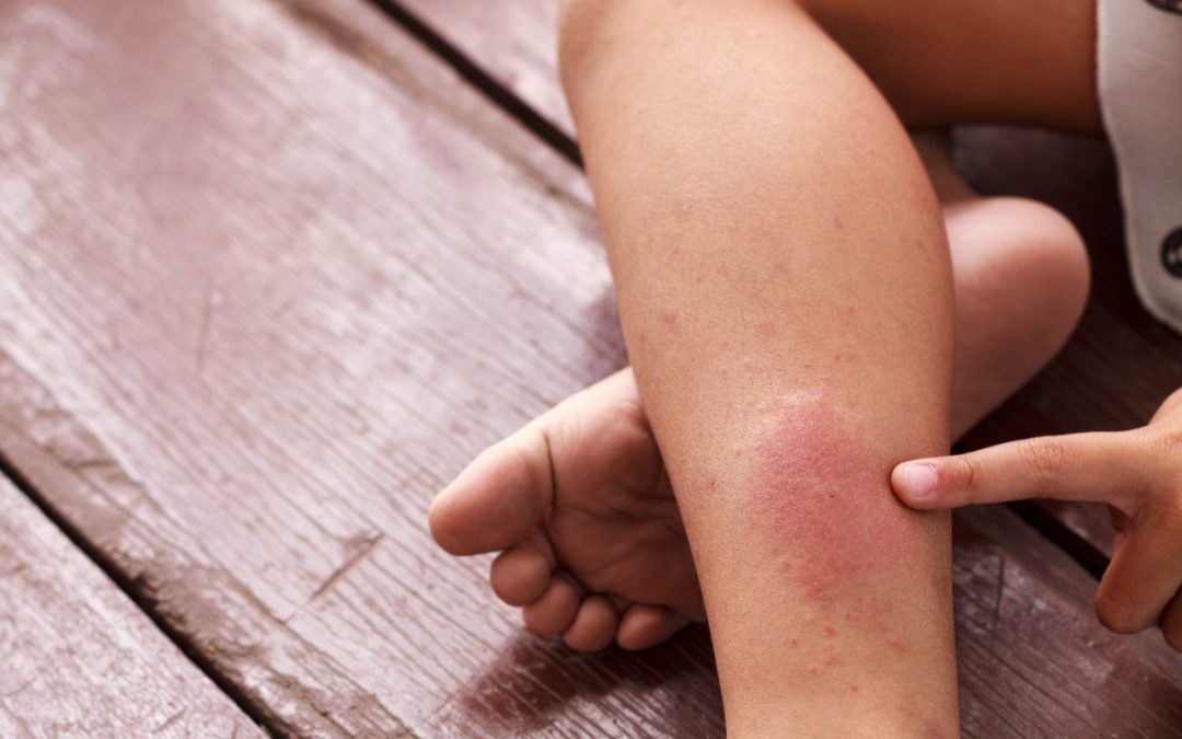 Día Mundial de la Trombosis: ¡Se puede prevenir a tiempo!