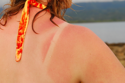 Salud recomienda proteger la piel durante el verano ante los rayos UV