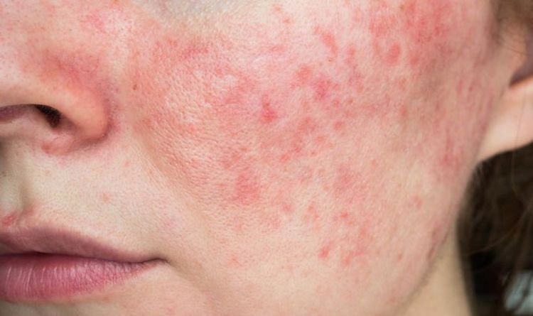 Clínicas ofrecerá charla sobre el lupus para saber cómo enfrentarlo