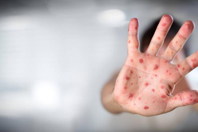 Viruela del mono: estos son los países que ya confirmaron varios casos