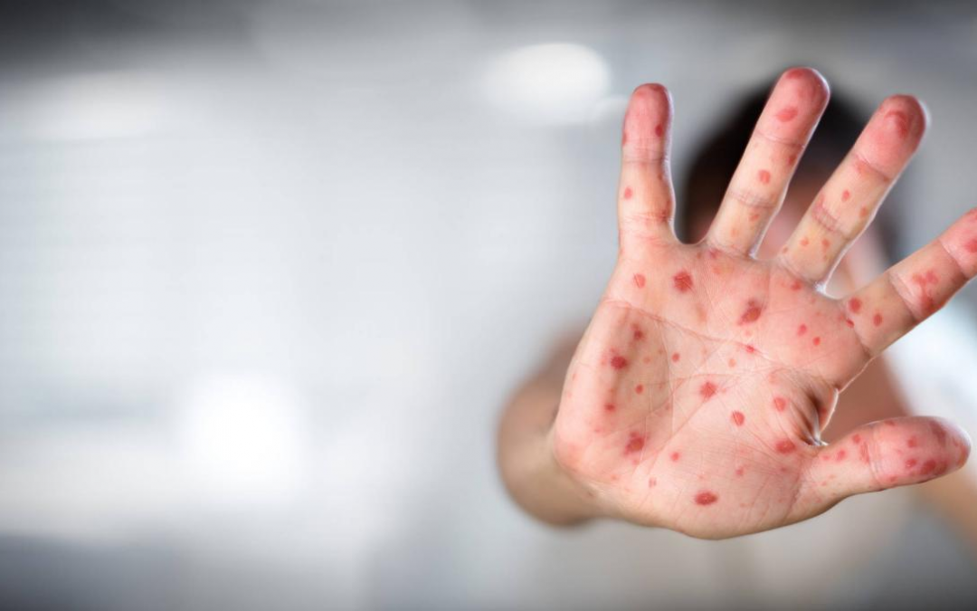 Ante viruela de mono, Salud activa alerta epidemiológica
