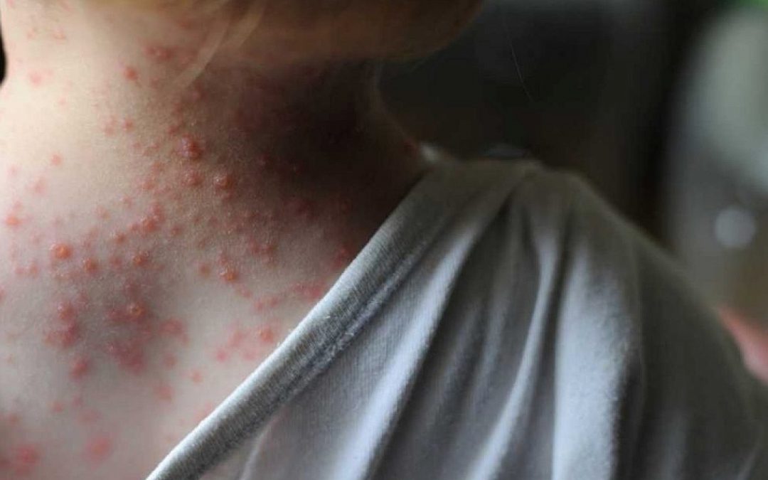 EE.UU: distribuirán vacunas a población susceptible ante alerta por viruela del mono