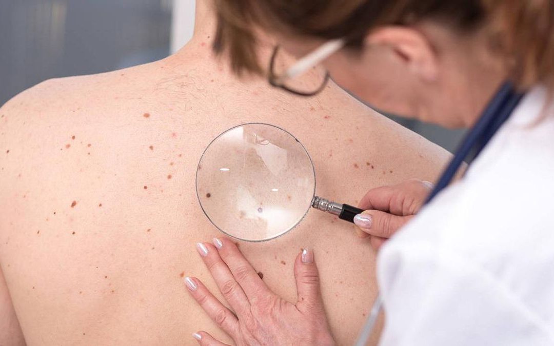 Melanoma: cuida tu piel, revisá tus lunares