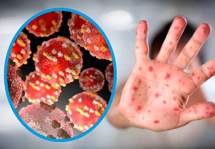 Medicina UNA explica qué es la viruela del mono y cómo se transmite