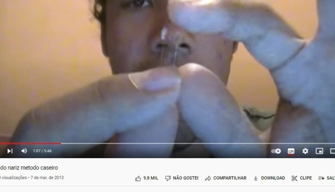 Brasil: se operó a sí mismo la nariz con tutorial de Youtube y terminó en el hospital