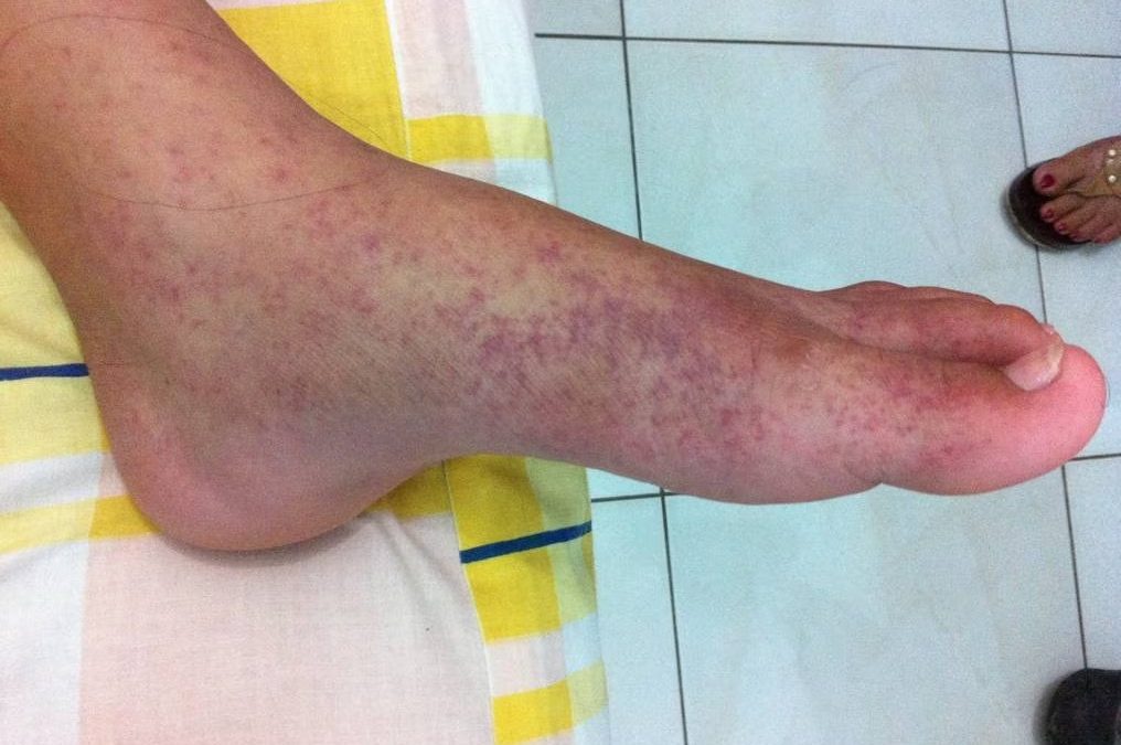 ¿Cómo aliviar las erupciones en la piel por chikungunya?