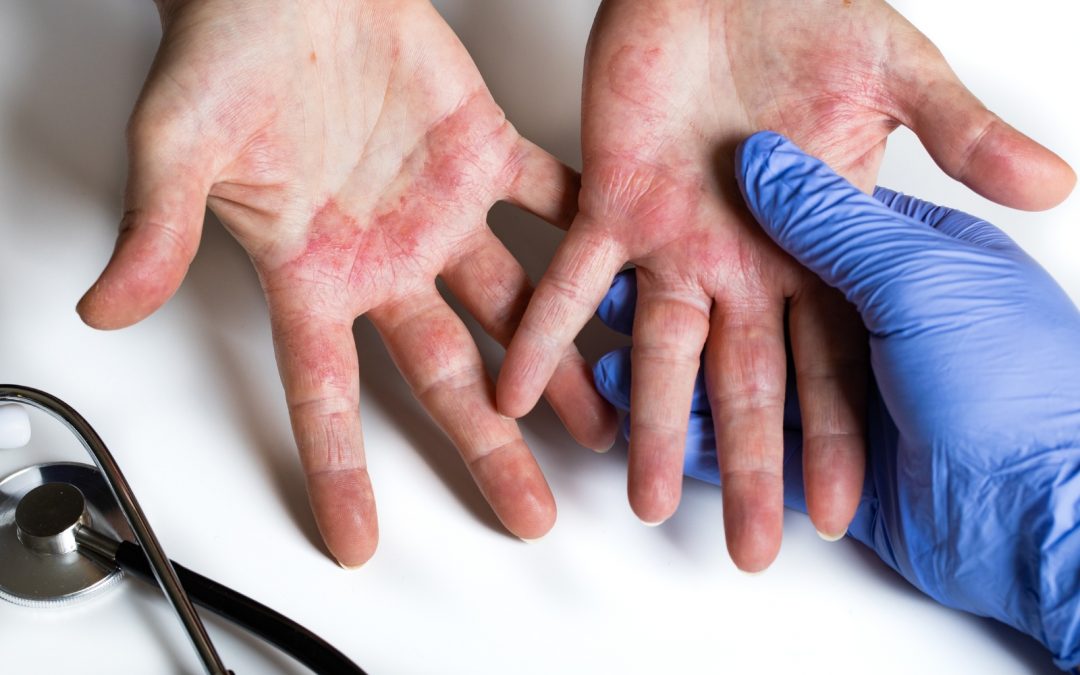 Dermatitis atópica en invierno: ¿Cómo tratarla?