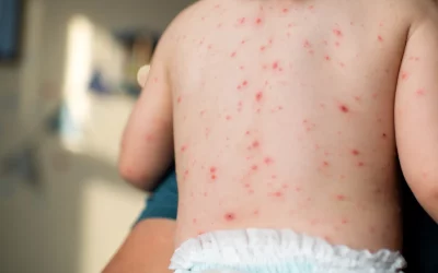 OMS alerta sobre alarmante incremento de casos de sarampión en Europa