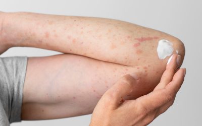 Recomiendan proteger la piel de pacientes con psoriasis en época de altas temperaturas