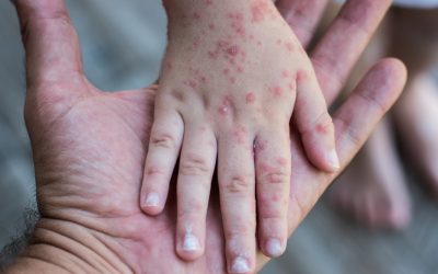Alerta por Sarampión: instan a la vacunación para evitar brotes