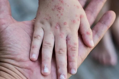 Alerta sanitaria en San Pedro: confirman 16 casos de sarampión