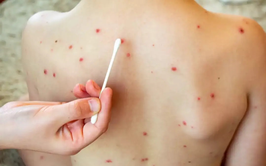 Confirman más casos de sarampión y emiten alerta epidemiológica