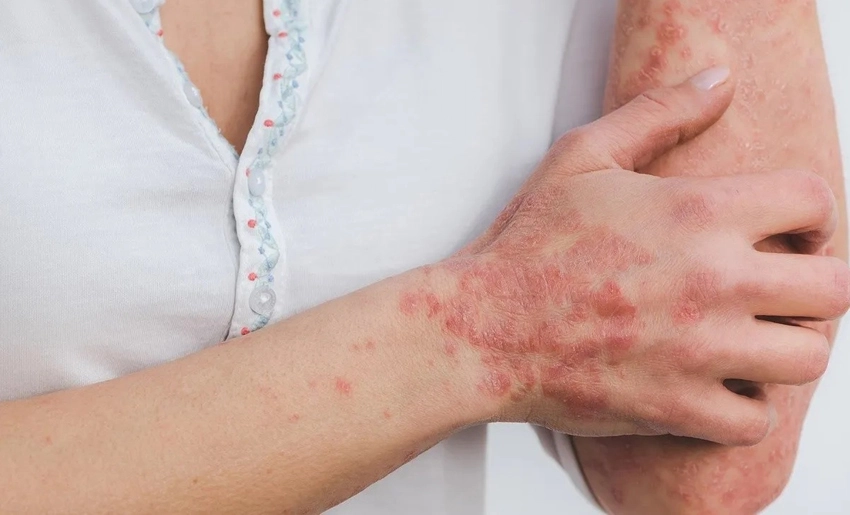 Salud reporta más de 200 casos de lepra en lo que va del año