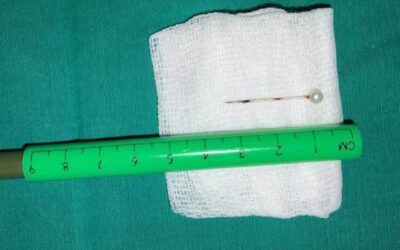Beba de 2 años tragó un alfiler: el objeto quedó alojado en su pulmón
